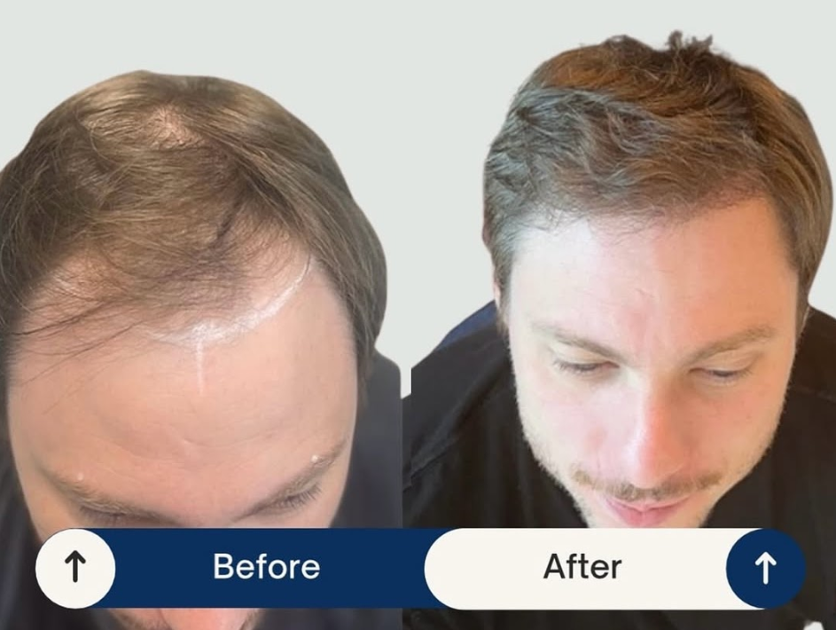 Resultados Antes y Después - Implante Capilar
