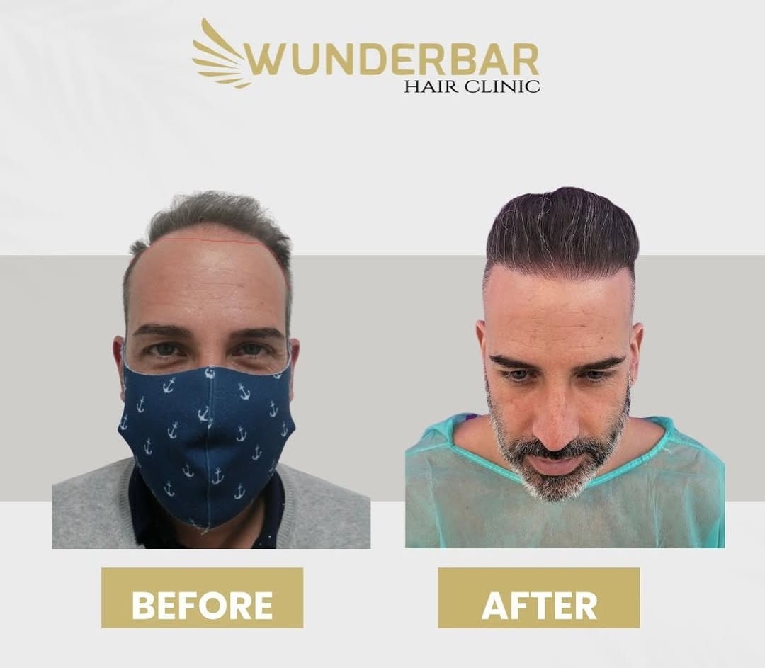 Resultado Implante Capilar - Antes y Después