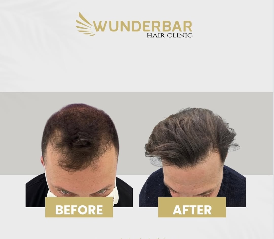 Resultado Implante Capilar - Antes y Después