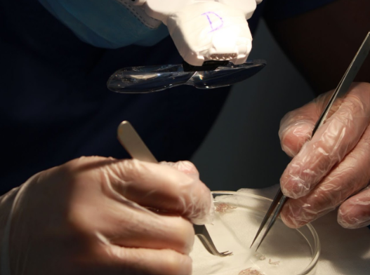 Técnica de Implante Capilar